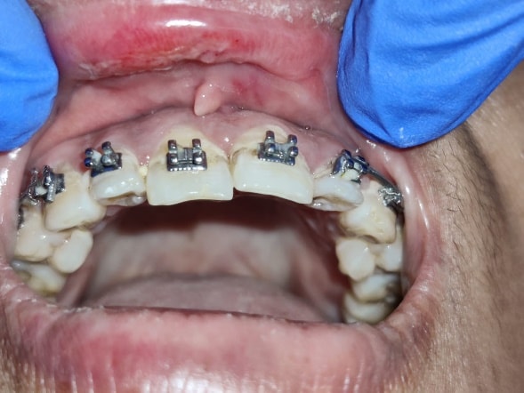 Management of Traumatized Central Incisor - Clinical result