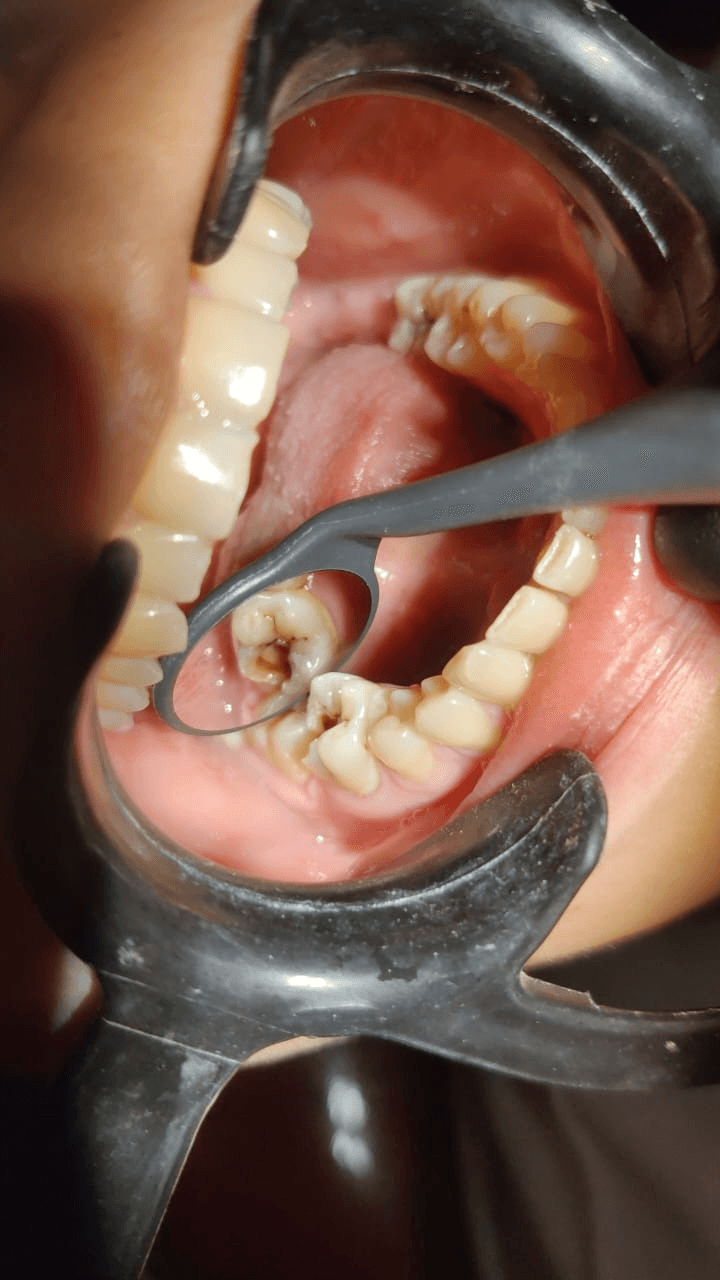 Fractured Instrument Bypass - Clinical result
