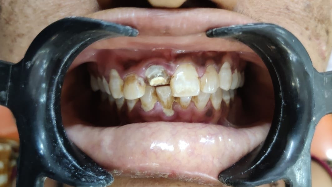 Apexification in Apical Root Resorption - Clinical result