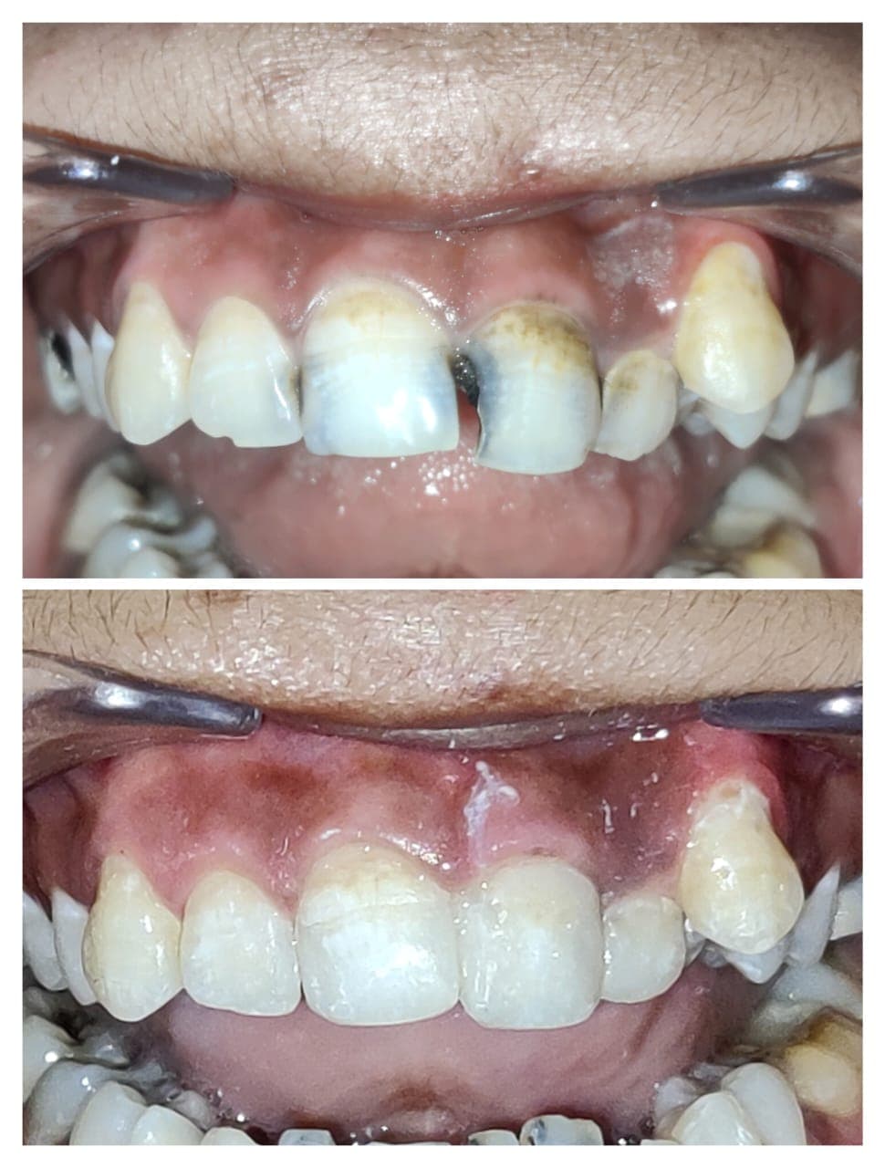 Class III Anterior Composite Restoration - Before and After