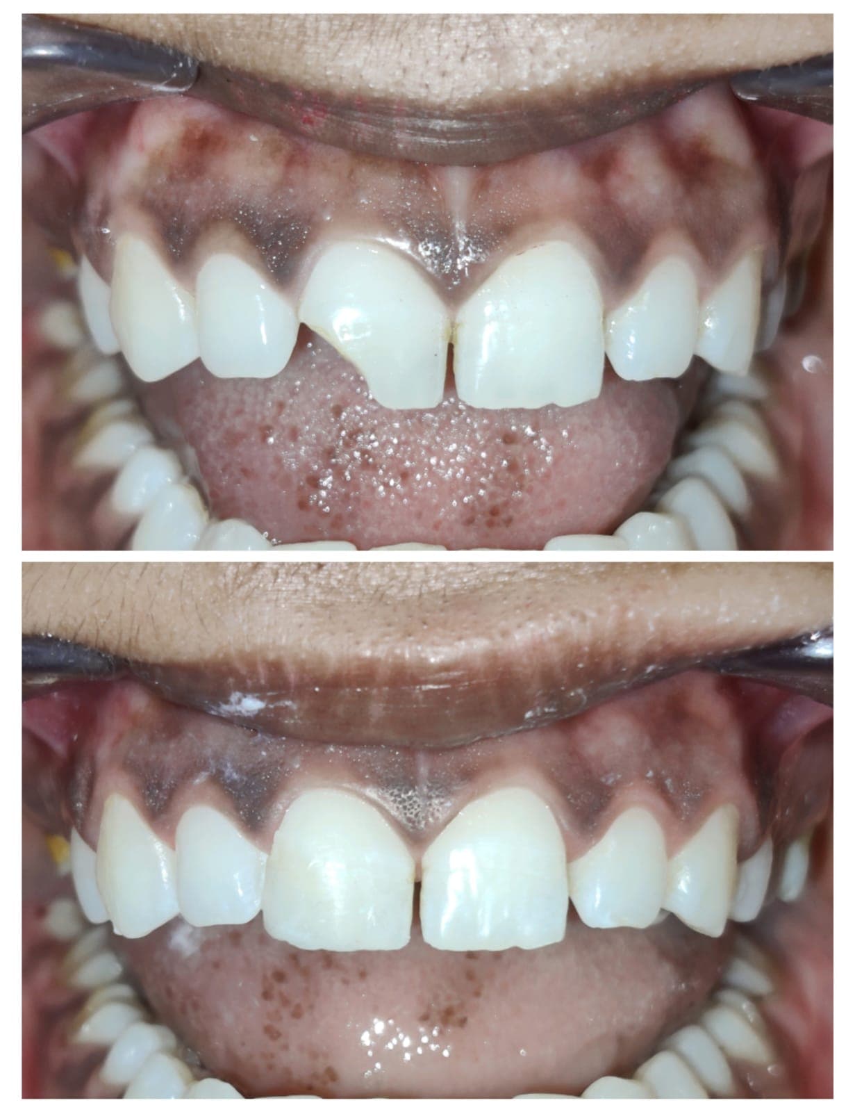 Class IV Composite Build-Up - Before and After